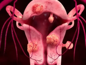 درمان فیبروم رحم