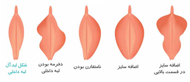 انواع شکل لابیا