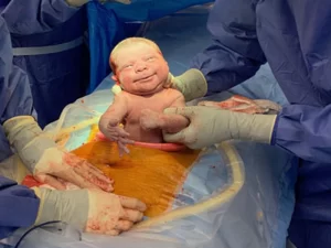 زایمان سزارین در قزوین