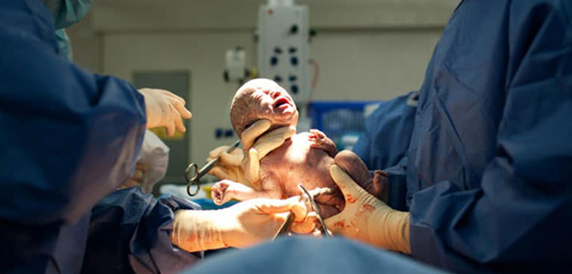 مراحل زایمان سزارین