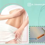 گذاشتن آی یو دی