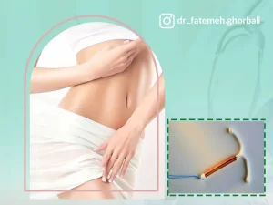 گذاشتن آی یو دی