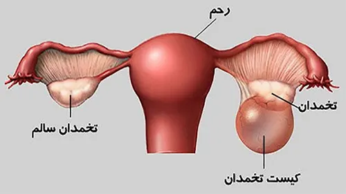 تخمدان سالم و تخمدان با کیست