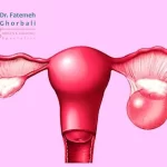 کیست تخمدان