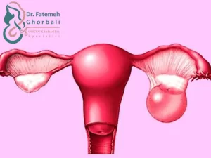 کیست تخمدان