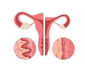 بهترین روش برای درمان خشکی واژن