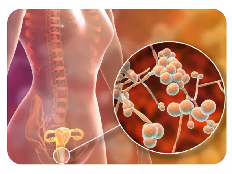 عفونت واژن چیست