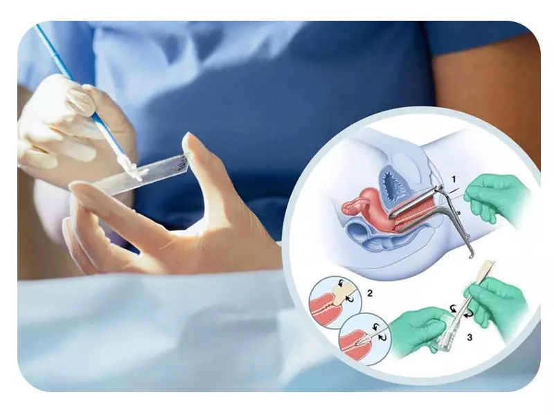 تشخیص عفونت واژن