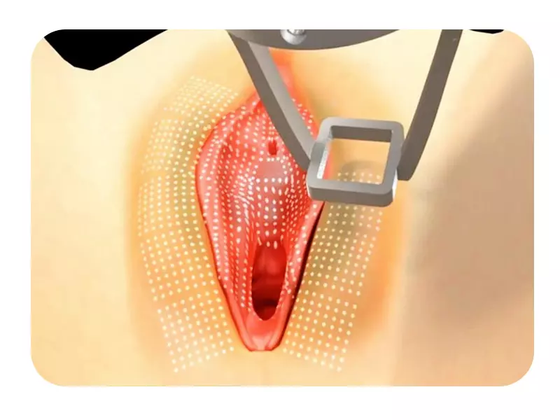لیزر برای سفید کردن واژن